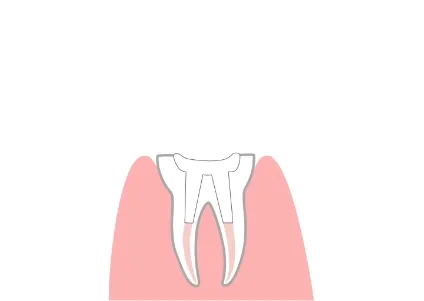 根管充填剤の充填