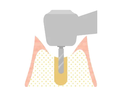 インプラントを埋め込む手術