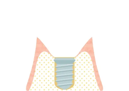 骨とインプラントが結合するのを待つ