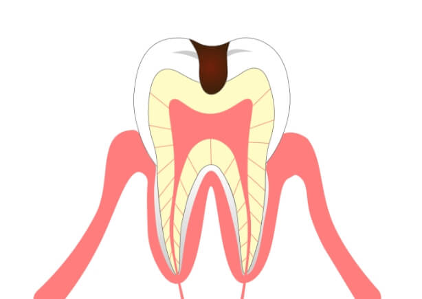 歯の内部まで進行した虫歯【Ｃ２：シーツ―】