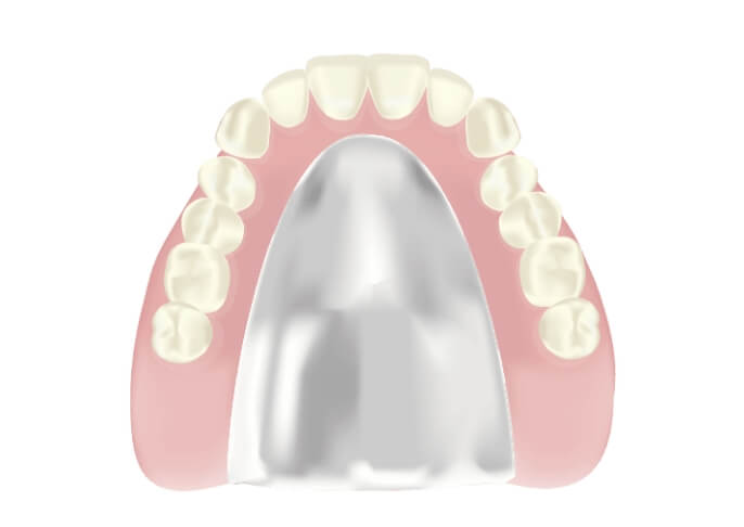 薄くて耐久性があるコバルトクロム床義歯