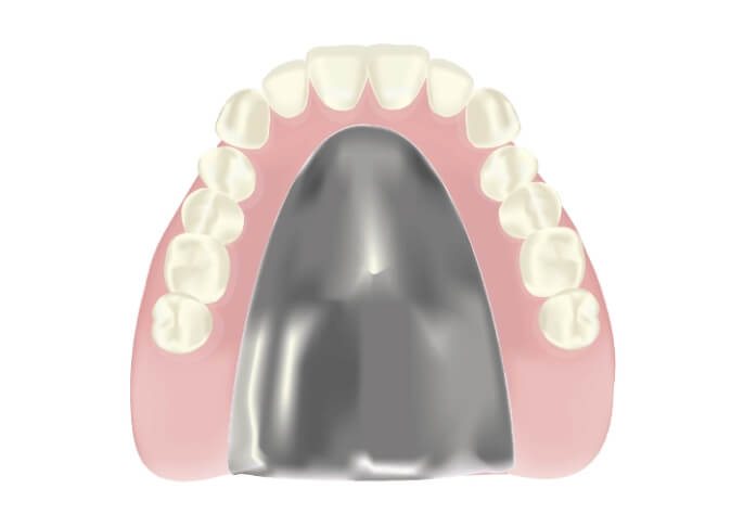 人体と親和性の高いチタン床義歯