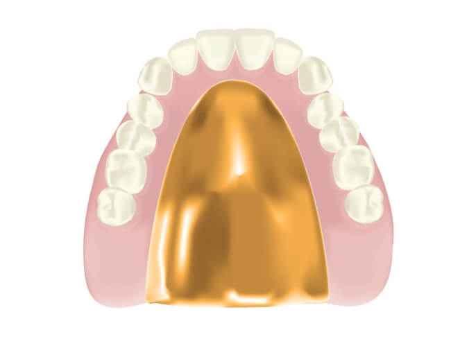 耐久性が高いゴールド床義歯