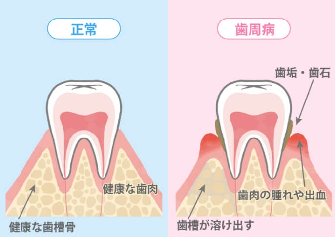 歯周病の原因は歯垢（細菌）